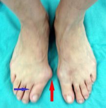 צילום קליני של כפות הרגליים. רגל ימין ניתן לראות בבירור את העיוות של הבוהן ניתן לראות בבירור את הבליטה של המפרק פנימה (חץ אדום) ואת סטיית הבוהן הצידה (חץ כחול)