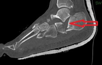צילום CT של השבר בו נראה בבירור התזוזה של החלק המפרקי עם פגיעה במפרק הסובטלארי (חץ אדום).